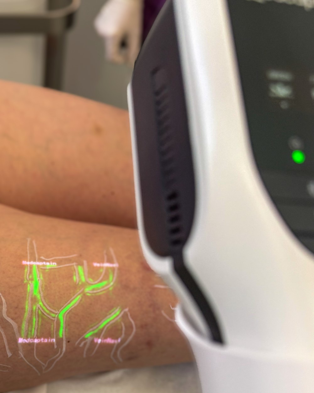 Augmented-Reality-Venenscanner projiziert die Nährvenen in Grün auf den Unterschenkel